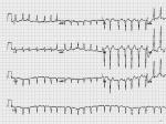 心房纤颤伴快速心室率Atrial fibrillation with rapid ventricular response