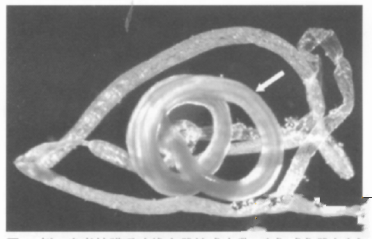 图2例2患者结膜吸吮虫雌性成虫及其蜕皮（白色箭头示虫体）体现显微镜下大体照相。