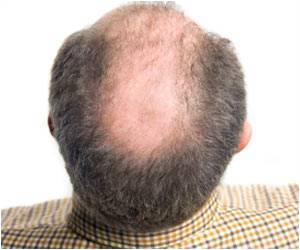 Hair Transplant Medication Propecia Boosts Sex Drive and Energy