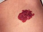草莓状血管瘤