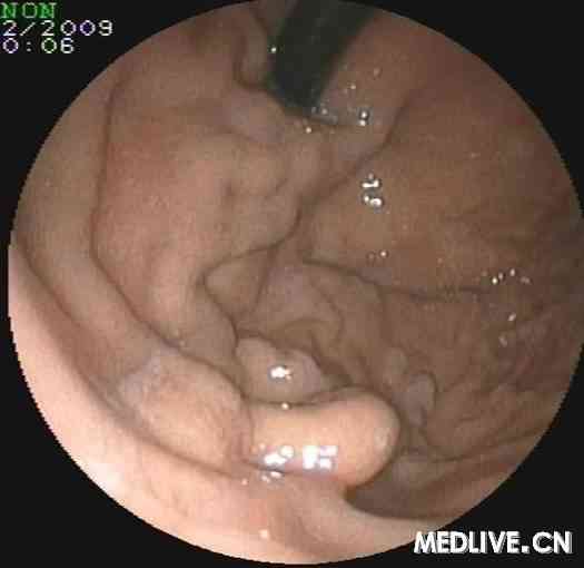 胃镜检查：食管胃底静脉曲张