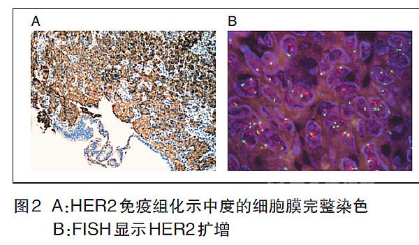 晚期HER2阳性胃癌规范化诊疗病例