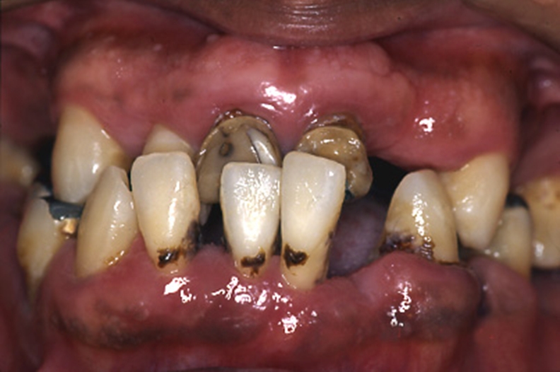 重度牙周炎需整体考虑、治疗 _ 牙科疾病